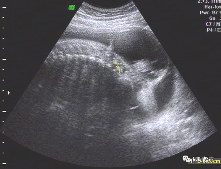 超详细图文:胎儿中晚孕超声常用切面及胎儿常见异常畸形