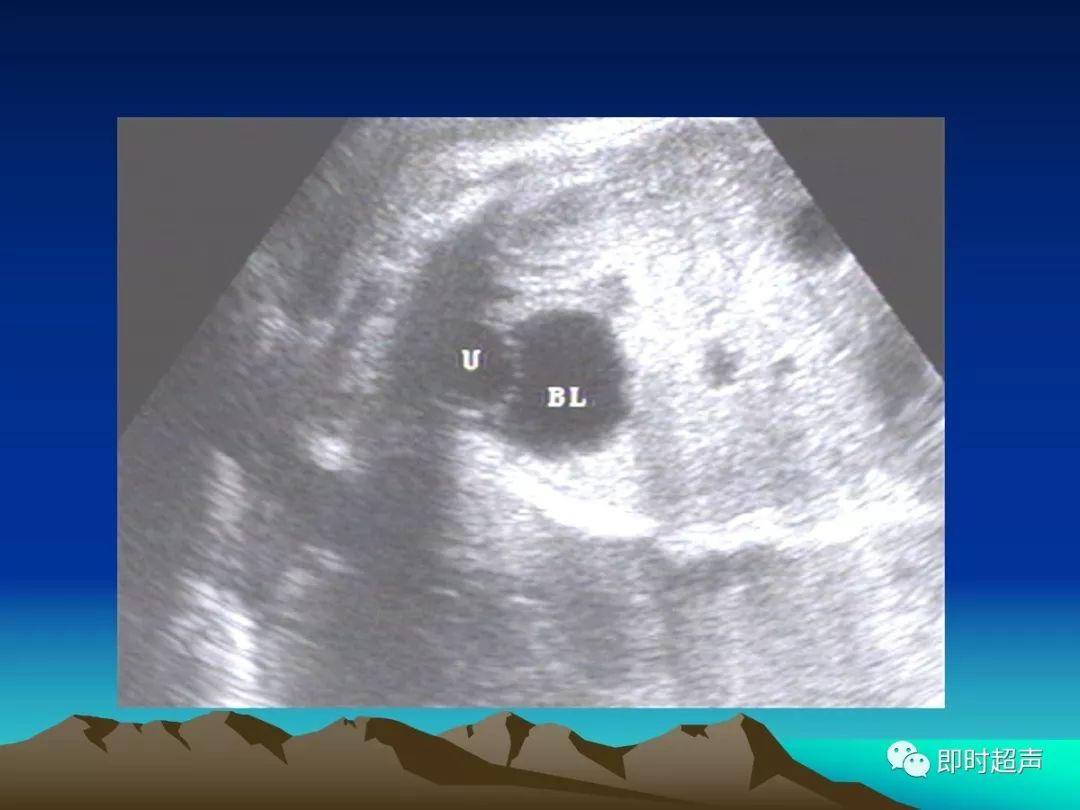 超詳細圖文胎兒中晚孕超聲常用切面及胎兒常見異常畸形