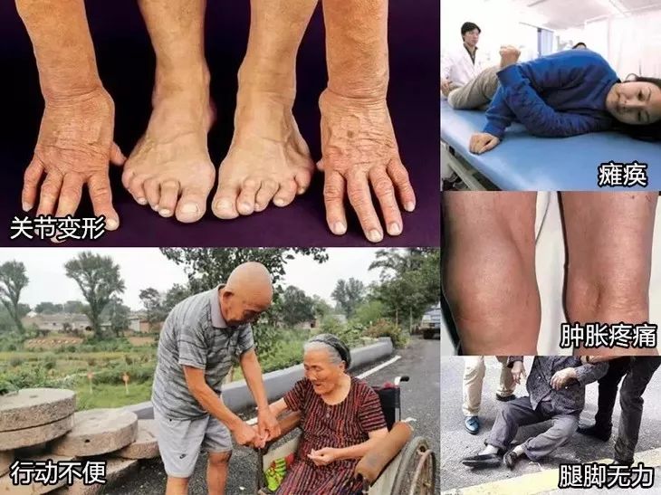 关节变形,行走困难,瘫痪在床膝盖就更易出现功能性障碍拖得越久,年纪