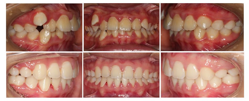 病例分享lorthguide03奥世美03数字正畸导航系统
