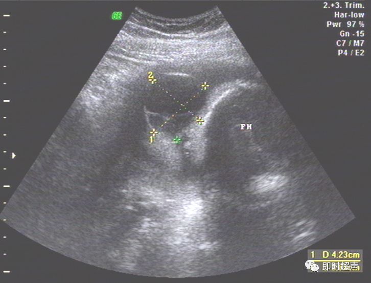 球拍状胎盘超声图片图片