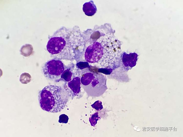 病例之腺癌细胞形态特点复习