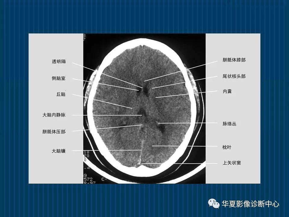如何分辨ct与mri图像