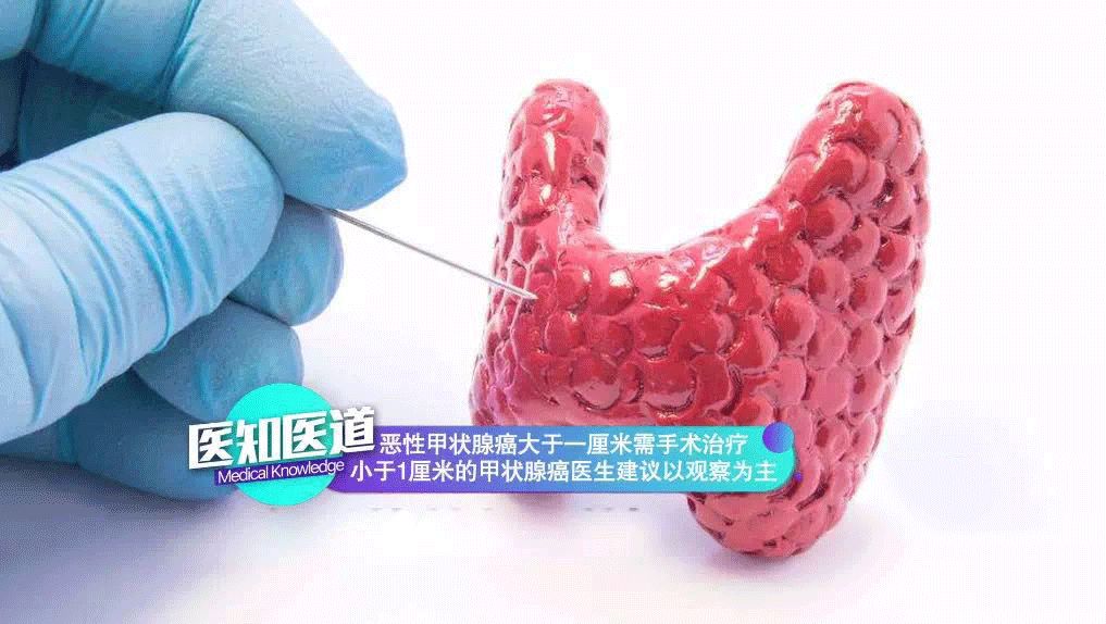 桥本氏甲状腺炎 能治愈吗 会不会癌变 你想知道的都在这 功能