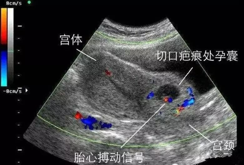 一例介入后宫腔镜下清宫(提示系剖腹产瘢痕憩室妊娠,一例直接超声