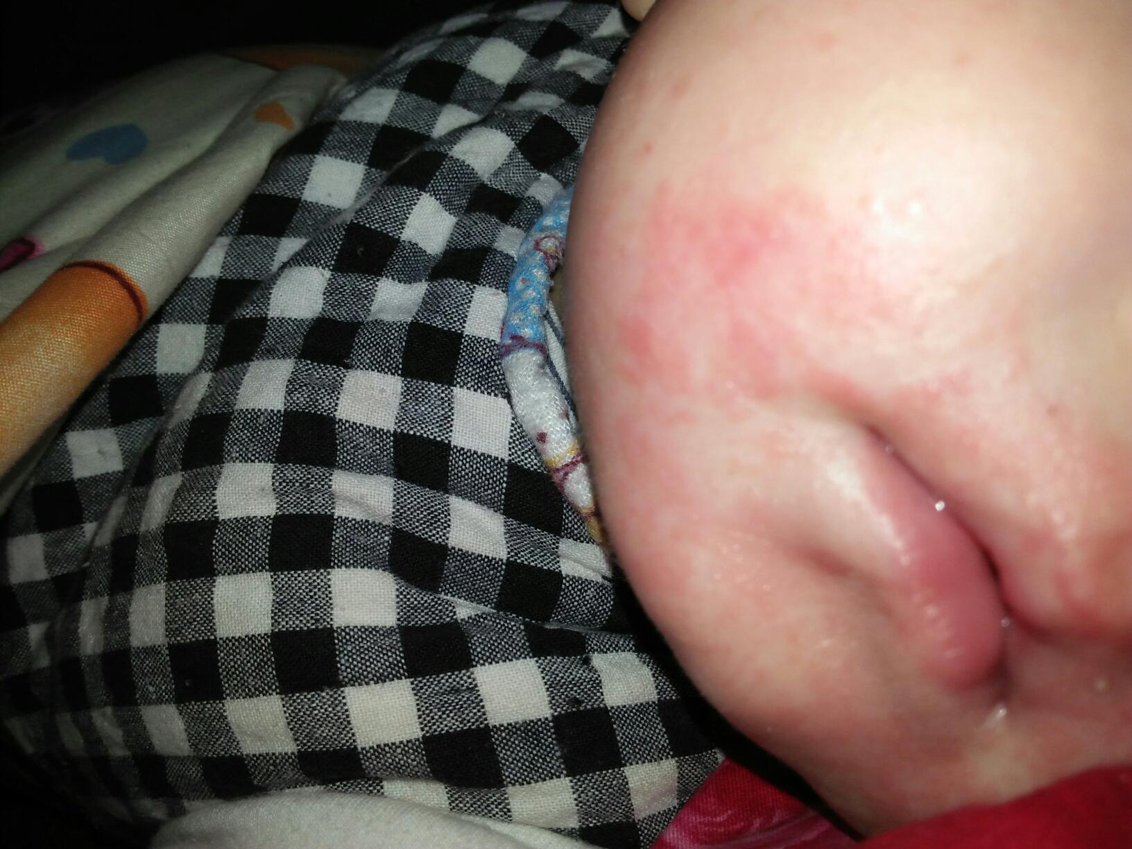 医生提醒:4类宝宝湿疹最易找上门,家长要注意3点,早日帮宝宝脱离痛和