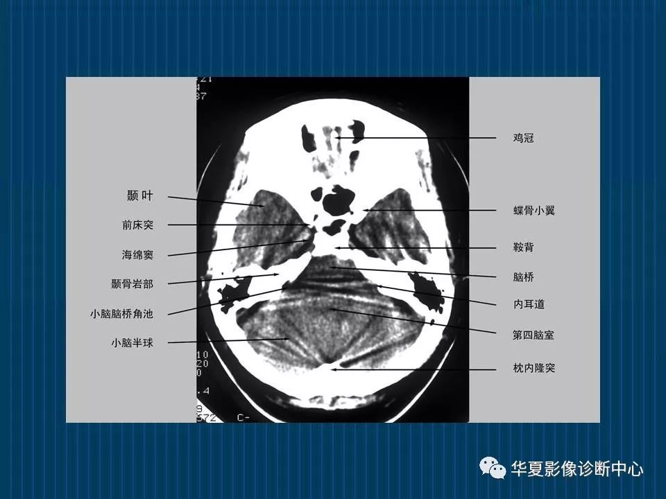 如何分辨ct与mri图像