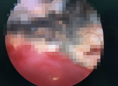 7岁小女孩下面流血走路不对劲医生一查竟是下体塞了这东西