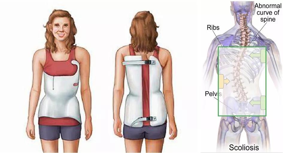 支具治疗的原理是通过髂骨,肋骨施加和侧弯顶椎相反的应力,达到矫正侧
