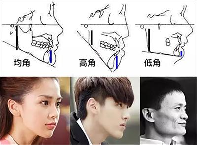 主要案例的难就难在,她是高角面型,但她只接受拔智齿,不接受拔4,5号牙