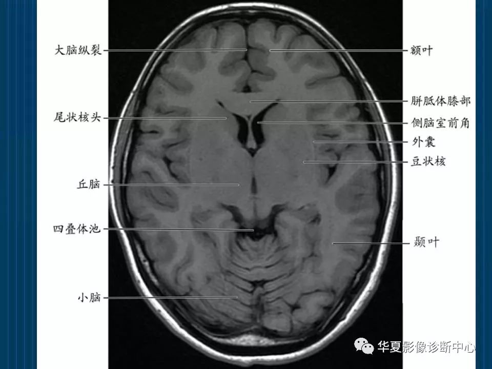 如何分辨ct与mri图像