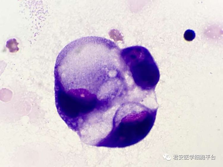 病例之腺癌细胞形态特点复习