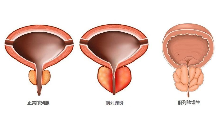 前列腺增生图片症状图片