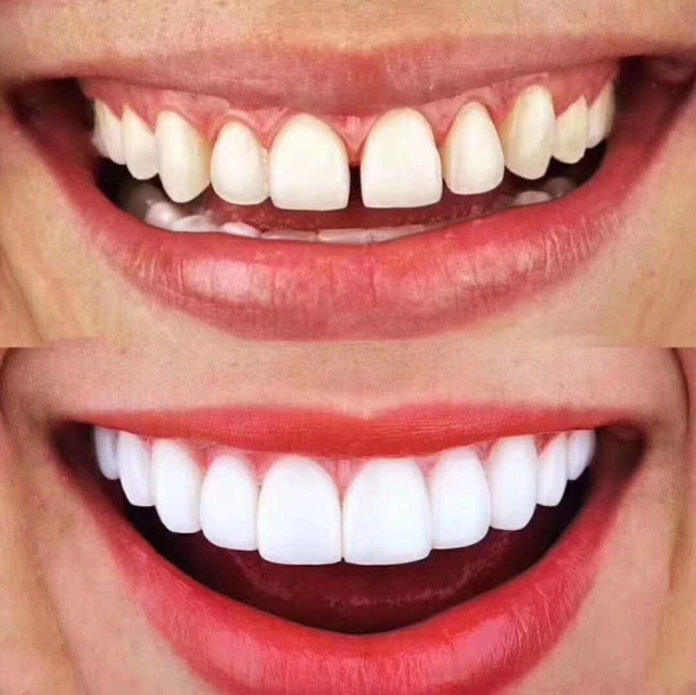 牙齿贴面,让牙齿重焕新生的秘诀!