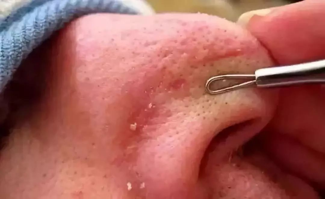 亲测丨又爽又恶心的去黑头方法来了5分钟将陈年黑头连根拔除