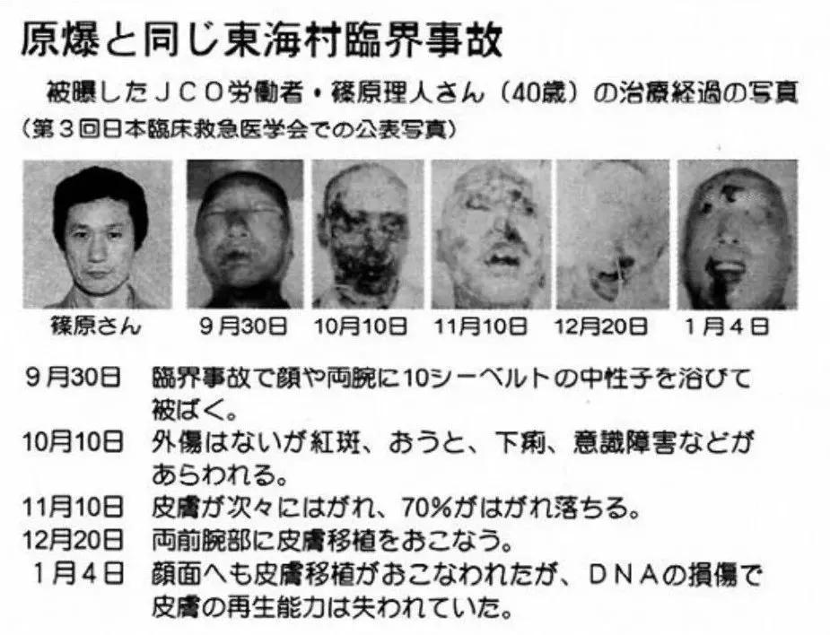 日本核辐射有多恐怖工人看着自己死去皮肤一点点剥落