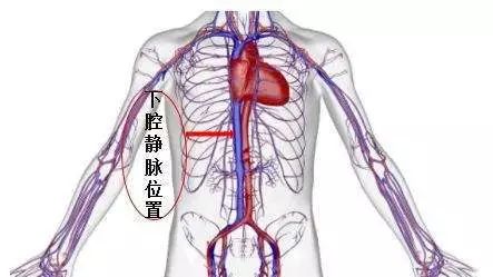 老王迅速完善相关检查,经检查最终被确诊为左肾恶性肿瘤伴下腔静脉癌