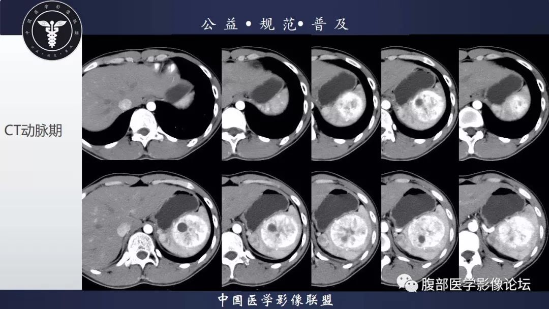 脾脏窦岸细胞血管瘤三例讨论及文献复习