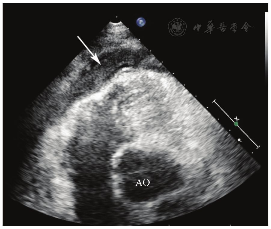 ao:主動脈;心尖部心包腔內可見血栓樣回聲(箭頭所示