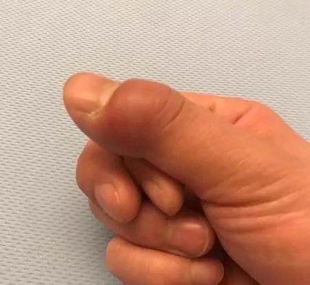 只是剪指甲 男星李易手指急性蜂窝织炎 这两个部位破皮最危险