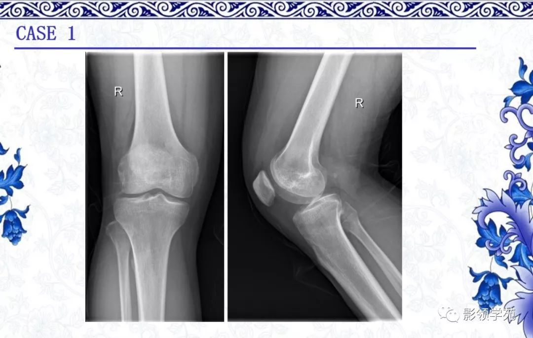 正常膝关节x线图片图片