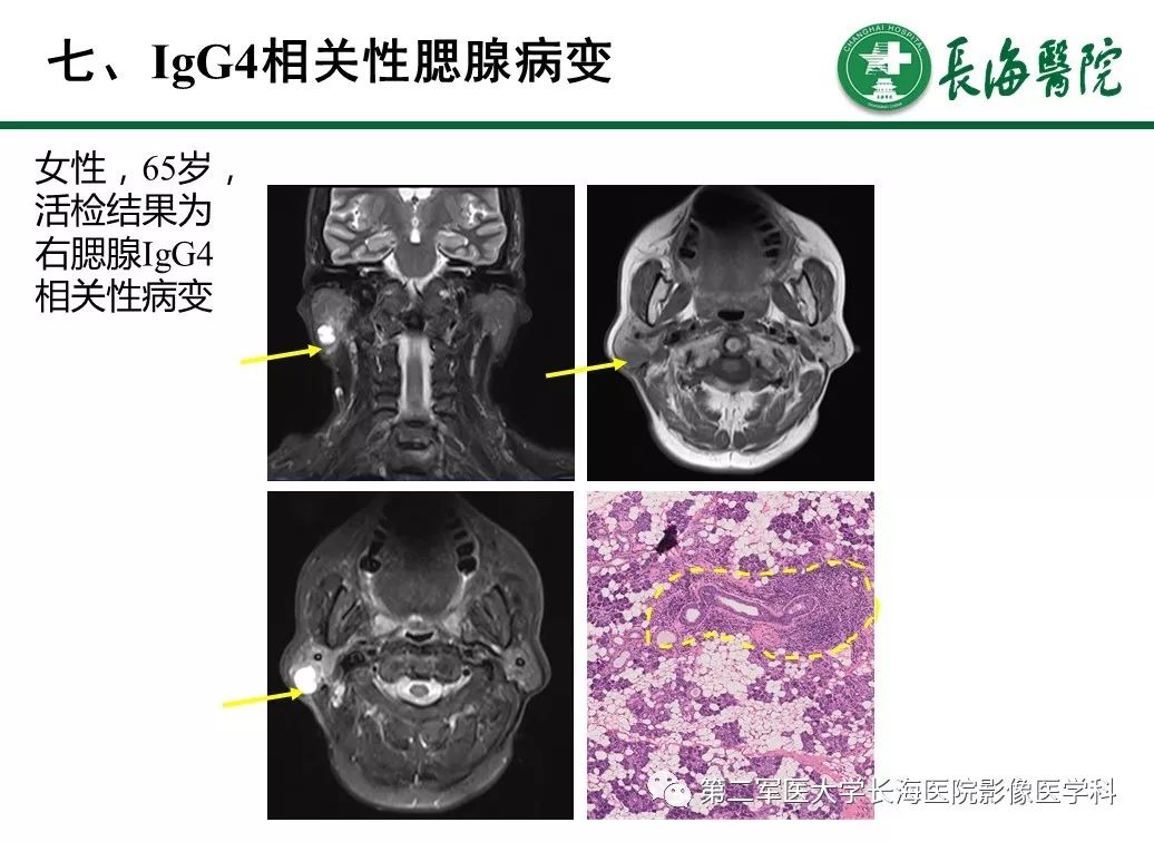 igg4相关性自身免疫性胰腺炎及相关性疾病