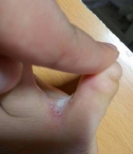 很多人早上出现这种小水泡,都是因为真菌感染而产生的脚气,所以说有