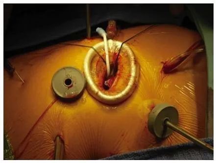 心脏微创瓣膜手术你怎么选择?_操作