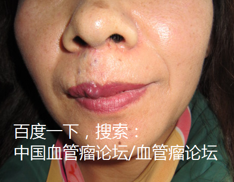 海绵状血管瘤
