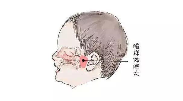 儿童腺样体肥大防护是关键