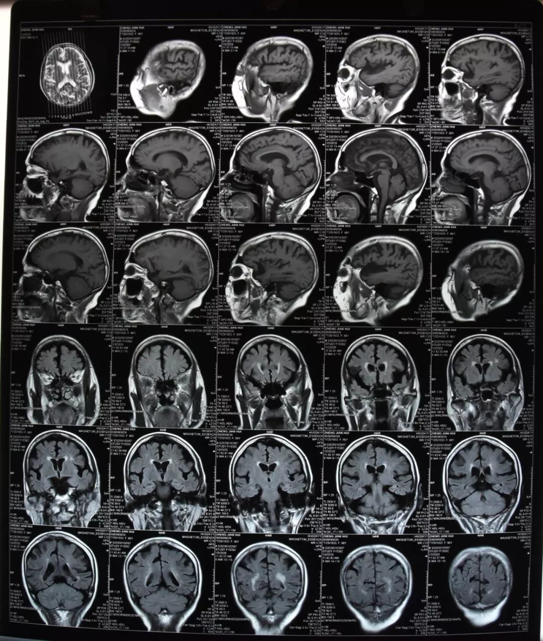 医生交待苏醒困难甚至性命难保第2天却醒来了