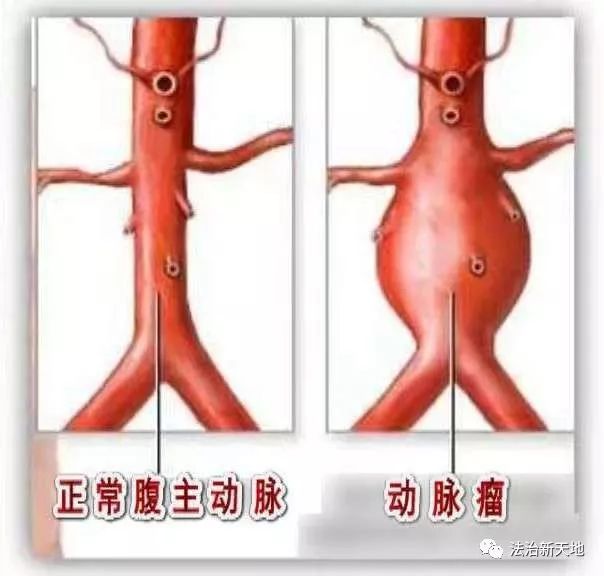 腹主动脉瘤的症状图片