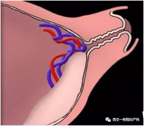 血管前置的产前超声识别二