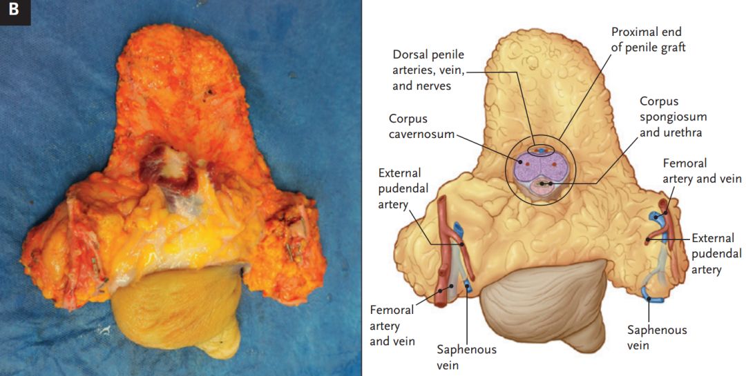 阴囊及睾丸缺失,阴茎背侧动脉和海绵体动脉缺失,而以往的阴茎移植手术