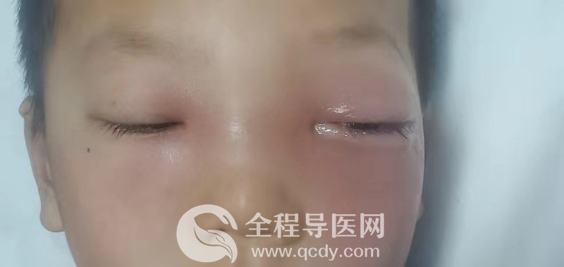 鼻窦炎引发眶蜂窝组织炎 危及6岁男孩生命--徐州市一院多学科联合施救