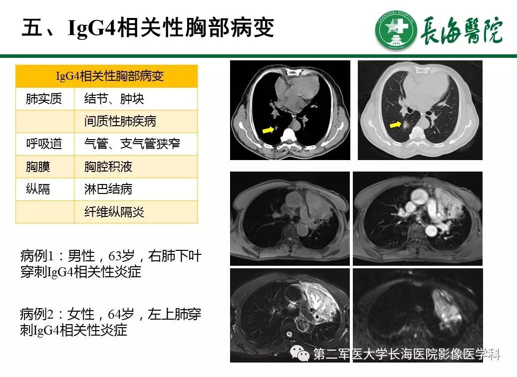 igg4相關性自身免疫性胰腺炎及相關性疾病