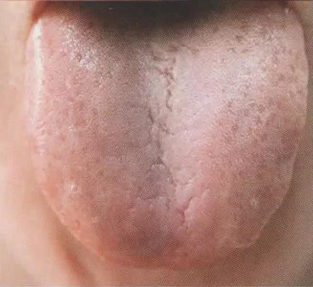 气虚体质舌苔图片图片