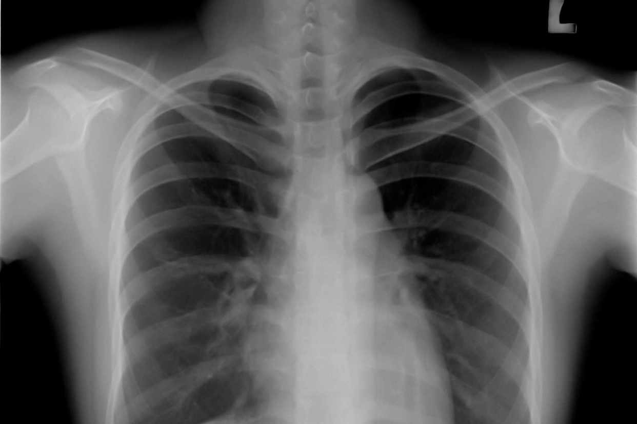 正常的肺部x光片图片