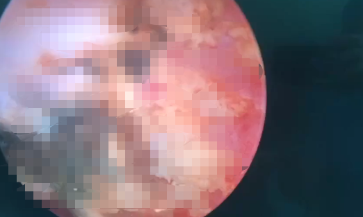 小女孩下体塞入异物流血不止隔了几天走路都不对劲了