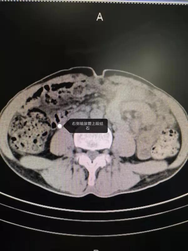 噁心嘔吐伴有腰痛可能會出現一些泌尿繫結石_輸尿管