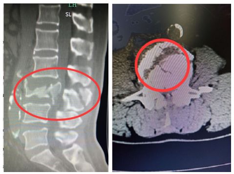 揪心台州一女子5米多高摔下屁股落地脊柱断成了两截这六个一提醒须