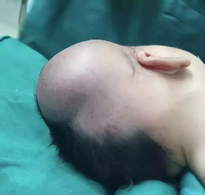 二孩孕妈正散步,宝宝突然头着地"掉出"!结果