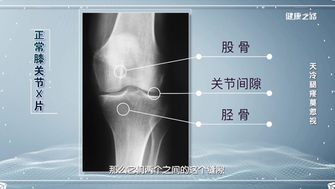 您可要小心骨关节炎!