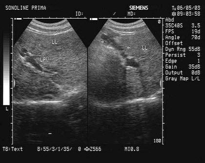 肝实质回声增粗,弥漫性病变,表示已经有肝硬化或肝纤维化吗?