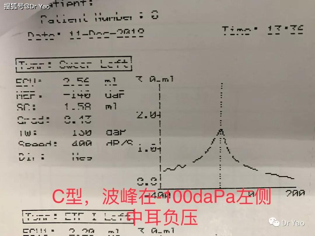 分泌性中耳炎,声导抗a,b,c型图什么意思?