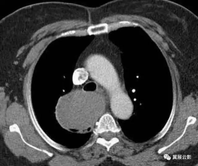 经典神经源性肿瘤病例盘点