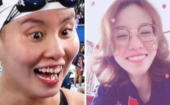 有种整容叫傅园慧摘掉牙套美到不敢认终于相信baby没有整