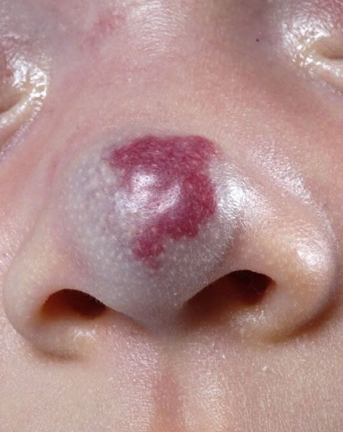 婴儿鼻子上有血管瘤图片