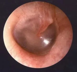 擤鼻涕的姿势错了,可能引起中耳炎,直到……_鼓膜