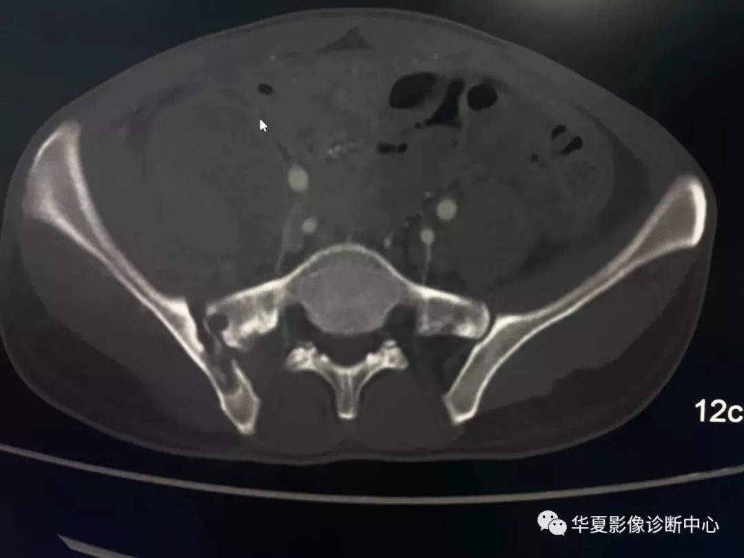 典型的结核伴冷脓肿!学到了!